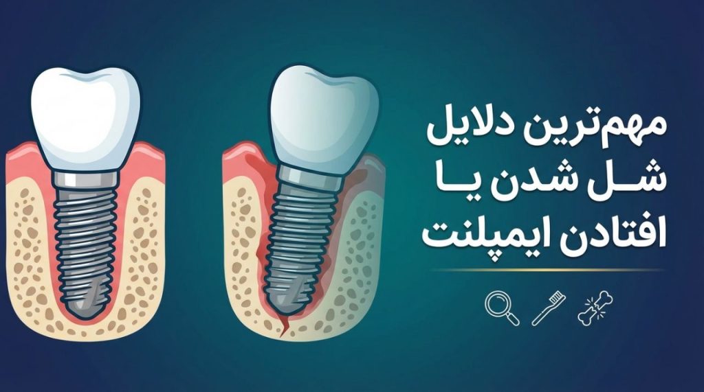 مهم ترین دلایل شل شدن یا افتادن ایمپلنتش