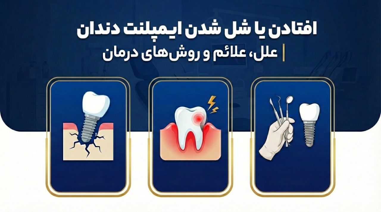 افتادن یا شل شدن ایمپلنت دندان