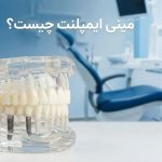 مینی ایمپلنت چیست