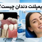 ایمپلنت دندان