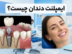 ایمپلنت دندان